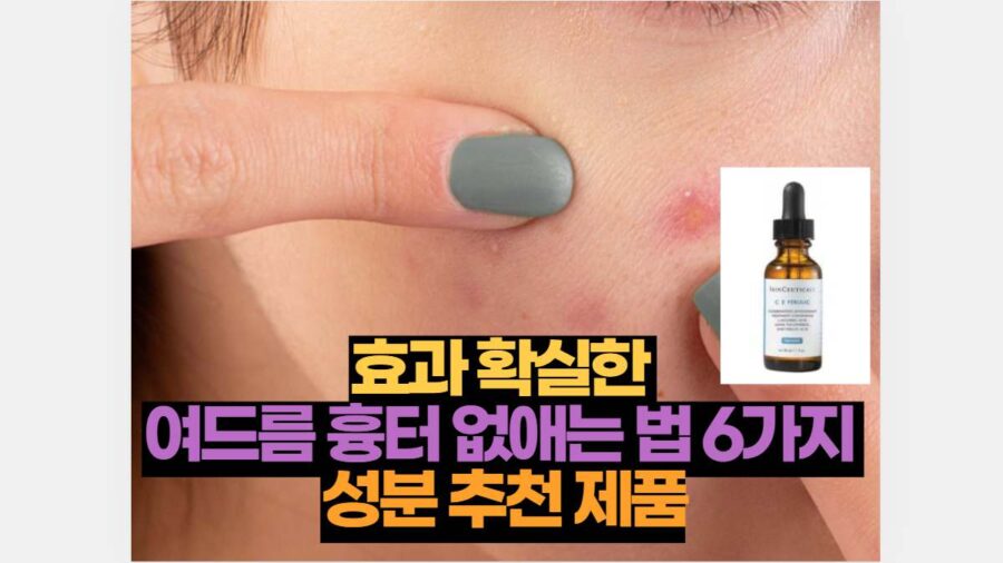 효과 확실한  여드름 흉터 없애는 법 6가지  성분 추천 제품