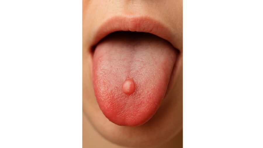 혀 돌기 생겼을 때 흔히 하는 실수 8가지 병원 가야 할지 구별 체크 2 혀 돌기, 병원 가야 할지 구별하는 7가지 체크
