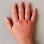 손 부음 원인과 해결법 손이 붓는 이유? 의심해야 할 6가지 건강 신호